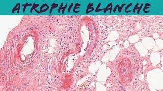 Atrophie blanche (livedoid vasculopathy) (dermatology dermpath pathology)