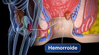 Así es el proceso para eliminar las hemorroides