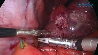 FlexDex - Laparoscopic Pancreaticoduodenectomy, Reconstruction - Dr. David Burnett