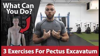 3 Exercises For Pectus Excavatum