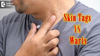 What Causes Skin Tags And Warts? | Get Rid of Warts & Skin Tags- Dr. Renuka Shetty | Doctors' Circle