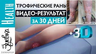 Трофические язвы (3D анимация) Причины и способы восстановления. НАШ ВИДЕО РЕЗУЛЬТАТ за 30 дней!!!