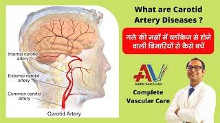 गले की नसों की बिमारियों से कैसे हो सकता है पैरालिसिस | जानें और बचें | Carotid Artery Diseases