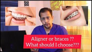 difference between aligners and braces?| aligners are better than braces!?