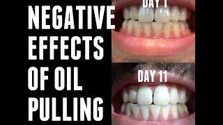 OIL PULLING EXPERIMENTS - Negative/Side Effects | Day 11