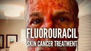Fluorouracil Skin Treatment - Before, During, and After