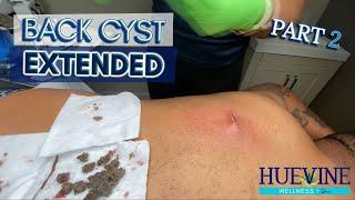 Part 2/3 Massive Back Cyst, Extended | HueVine
