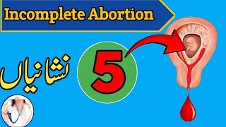 Incomplete abortion symptoms (Hamal zaya howa k nahi ? )
