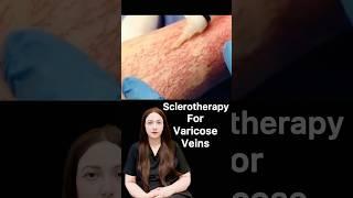 Sclerotherapy #shorts #shortsfeed #shortsvideo #viralvideo #viralshorts #viralshort #youtubeshorts