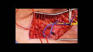 AUA2018 V09-01 Bladder Extrophy Radial Artery Phalloplasty  Extrophy Related Issues