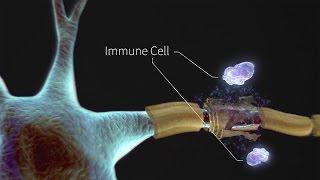 What is Multiple Sclerosis?