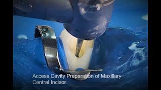 Access Cavity Preparation of Maxillary Central Incisor