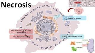 Necrosis : cellular mechanism and types