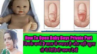 How To Open Baby Boys Private Part  प्राइवेट पार्ट को कैसे खोलें नहीं खुला है तो विडियो जरूर देखें