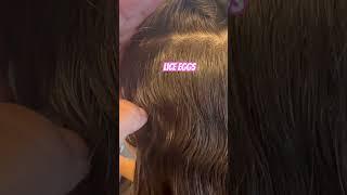 Lice eggs l lice removal service l Stacey the louse girl