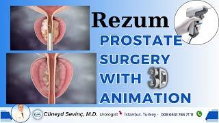 Rezum Prostate Surgery with 3D Animation