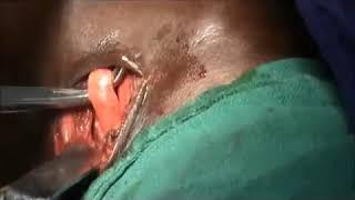 Carotid Artery Ligation DNB ENT OSCE Surgical Video station DnbMentors