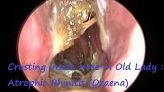 Crusting inside Nose in Old Lady : Atrophic Rhinitis (Ozaena)