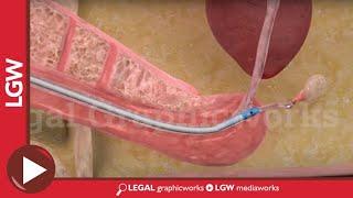 Urethral Catheterization and Rupture 3D animation