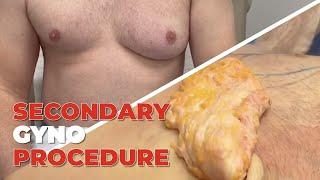 Secondary Gyno Surgery With MASSIVE Gland Removal