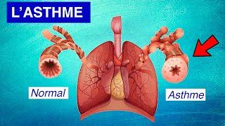 Asthme bronchique : Physiopathologie, Symptômes et Traitements