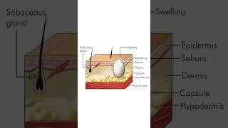 Sebaceous cyst - General Surgery