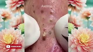 Relax squeezing out blackheads #52 Черные точки