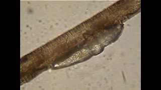 Demodex brevis moving on eye lash