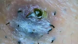 Popping huge blackheads and Pimple Popping   Best Pimple Popping Videos #40