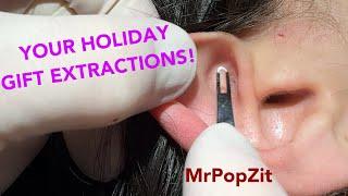 Just in time for the holidays! Acne extractions! Blackheads, whiteheads, nodules. Clearing pores!