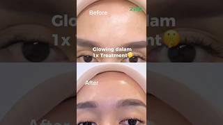 Wajah Glowing Dalam 1x Treatment, Coba Insta Glow Serum Micro Injection Hanya Di ZAP