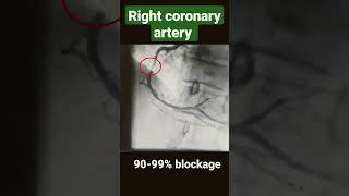 Right coronary artery with 80-90%, 90-99% and 100% blockage ( angiography) #shorts