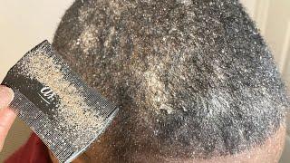 Close up Scalp Cleanse ASMR. We Scratch. You Relax