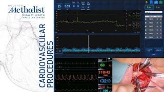 Transcranial Doppler Monitoring During CEA (Lumsden MD, Garami MD, Berczeli MD, Sinha MD, Tekula MD)