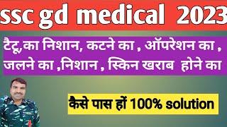 ssc gd medical / ssc gd टैटू /  ssc gd कटे जले ऑपरेशन का निशान / ssc gd medical process / ssc gd