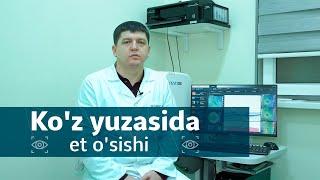 Ko'z yuzasida et o'sishi | Dr.zohidjon