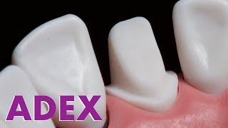 ADEX #9 Ceramic Crown Preparation | Fixed Prosthodontics