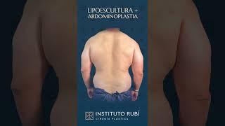 Resultado antes y después de cirugía plástica de lipoescultura con abdominoplastia