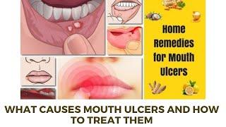 Home remedy for mouth ulcers | What Causes Mouth Ulcers and How to Treat Them