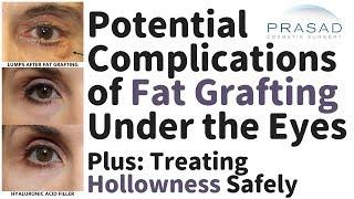 Why Fat Grafting is Not Advised Under the Eyes to Treat Hollowness, and a Safer Treatment