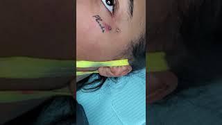 removing dermal piercing