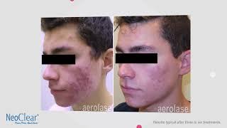 NeoClear by Aerolase - Patient Seeking Acne Laser Treatments