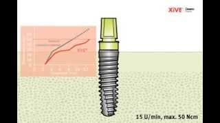 Система имплантов Xive. Немецкий имплантологический центр