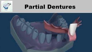 Removable Partial Dentures
