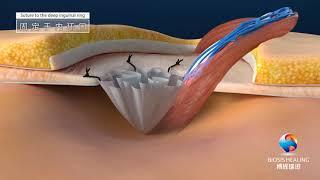 Polypropylene Plug Mesh for Hernia repair