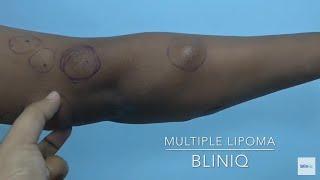 Multiple Lipoma Removal By Dr Ashwani Kumar At Bliniq Cosmetic Surgery Centre