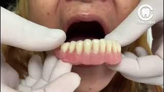 DENTAL PROSTHESIS without ACRYLIC on the LIP 