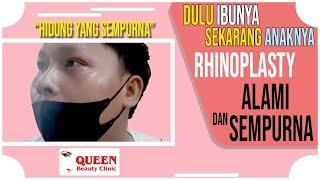 DARI IBU SAMPAI KE ANAK CUMA MAU RHINOPLASTY DI KLINIK QUEEN?