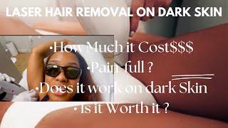 Laser Hair Removal on Dark Skin 2024. All questions answered. I also got scammed Storytime