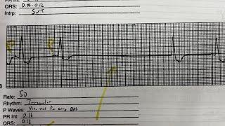 Sinus node dysfunction: pause vs arrest vs exit block